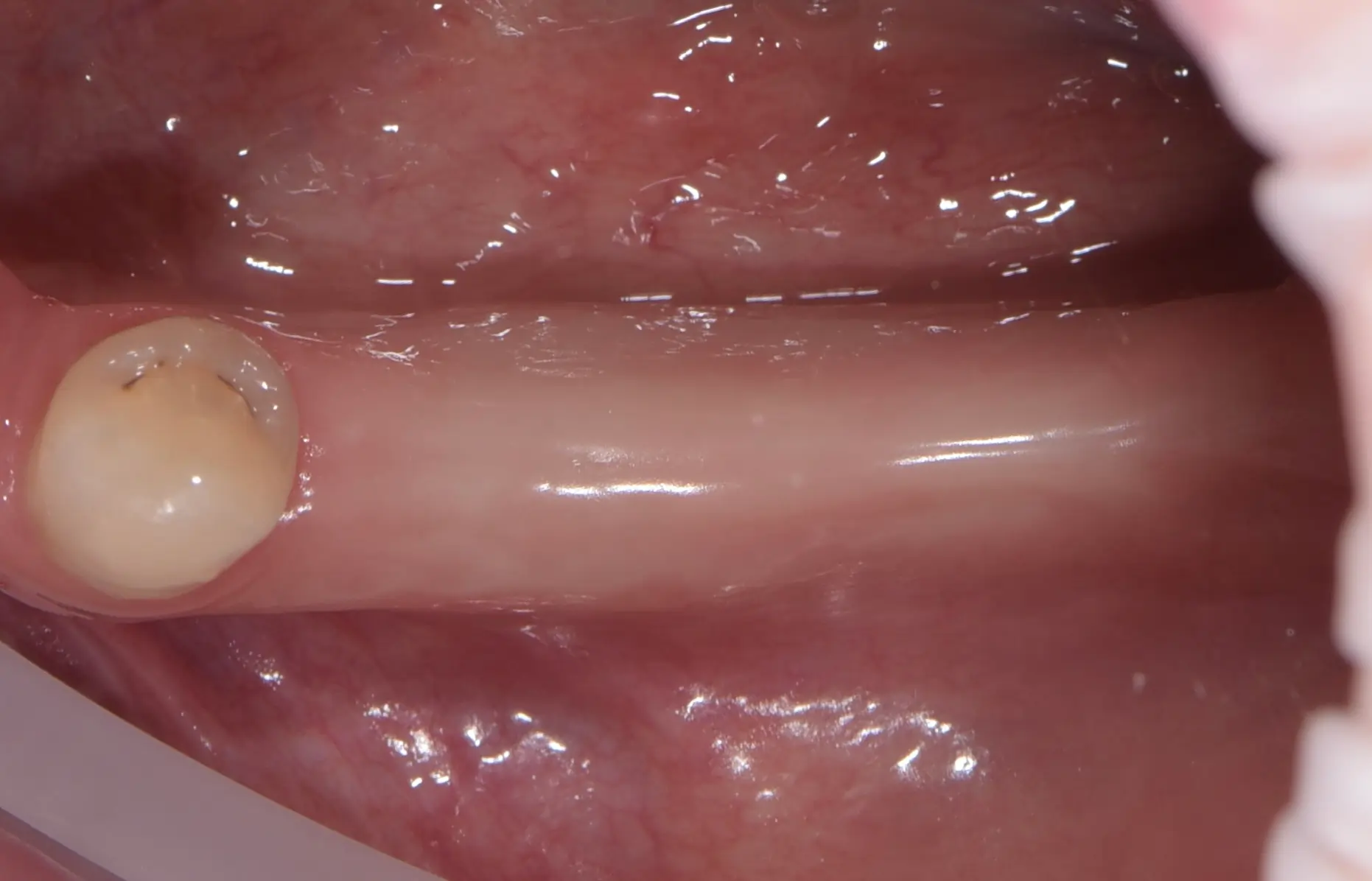 Przypadek 6 - Implantacja w szczęce