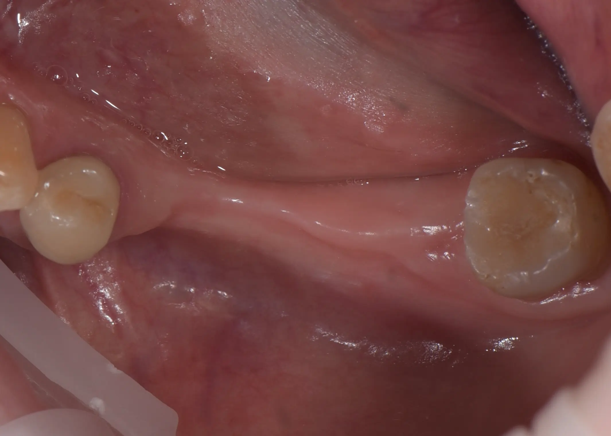 Przypadek 7 - Augmentacja kości w szczęce