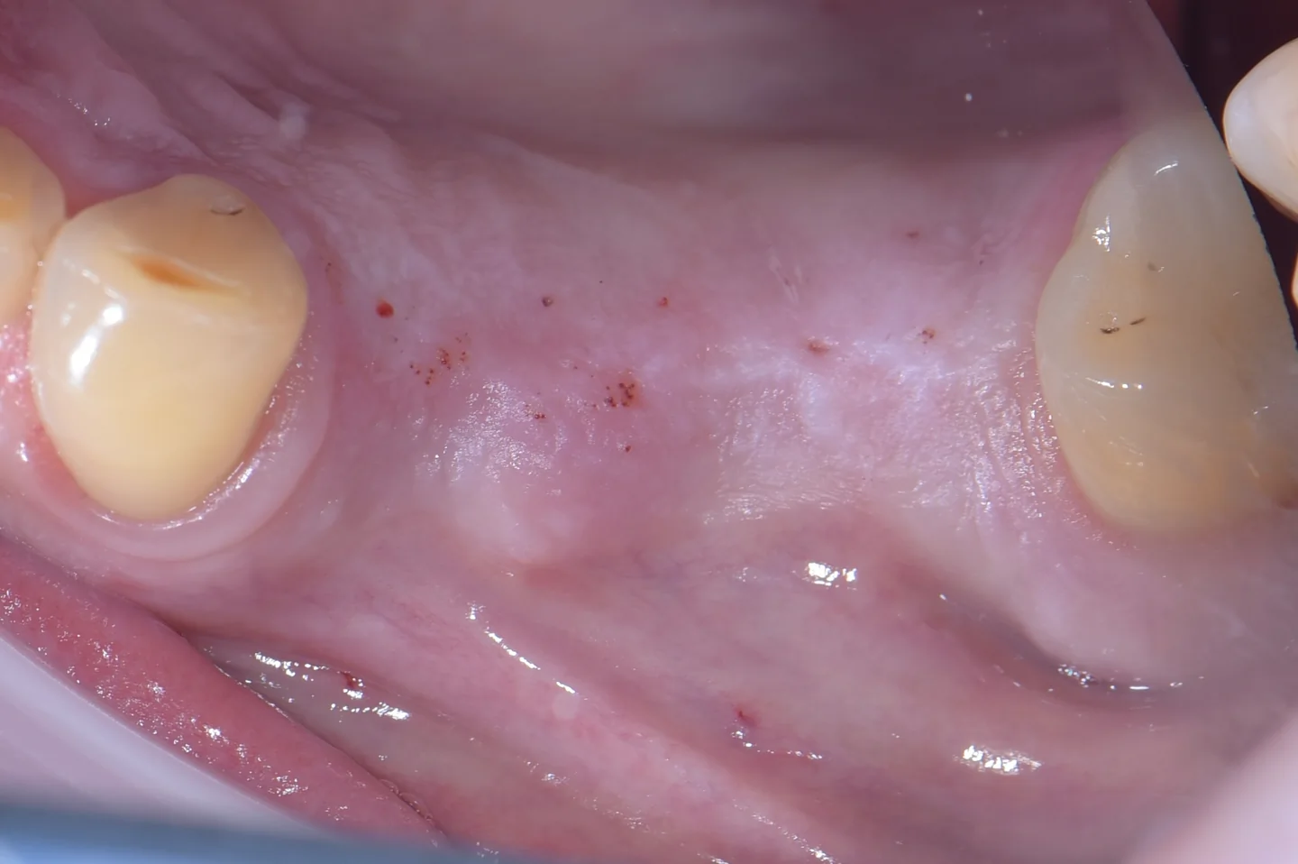 Przypadek 8 - Otwarty sinus lift